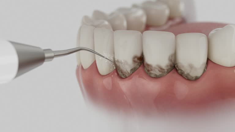 Trusted Wisdom Tooth Removal service in Bottineau, ND - Dentist Open Now